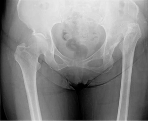 Doğuştan Kalça Çıkığı Belirtileri ve Tedavisi